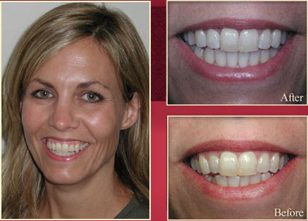Blonde woman showing her before and after smile