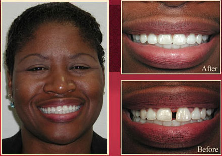 Actual patient before and after gap smile
