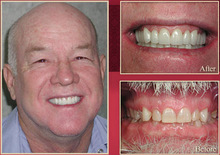 Male before and after dental procedure