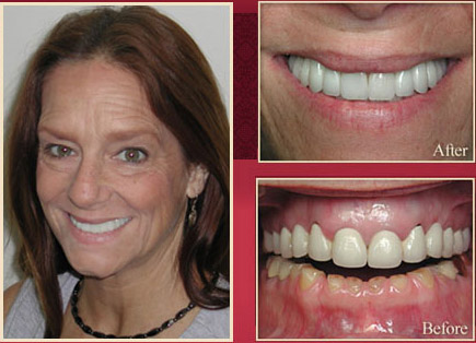 Female patient before and after smile