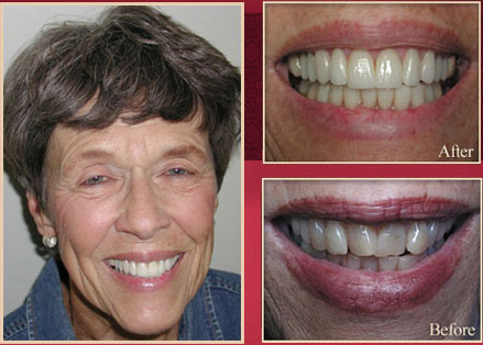 Elderly female patient before and after dental procedure