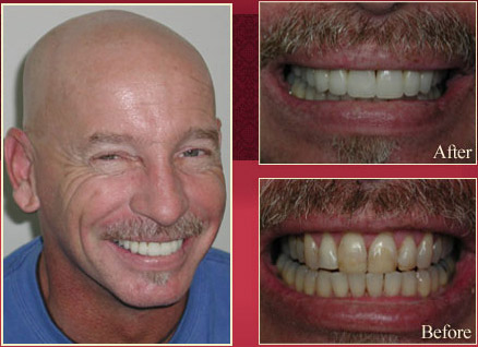 Patient showing his before and after procedure
