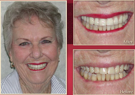 Elderly woman before and after smile