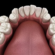 Illustration of crooked teeth