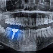 X-ray of dental implant in Los Alamitos, CA after osseointegration