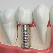 Three-dimensional model of restored dental implant in Los Alamitos, CA