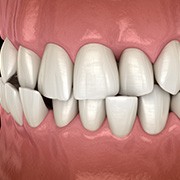 Illustration of a crossbite