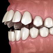 Illustration of an open bite