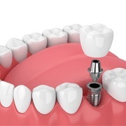 dental implant post, abutment, and crown being placed in the mouth