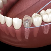 Flossing dental implant in Los Alamitos