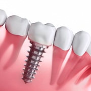 3D illustration of a dental implant and the rest of the smile 