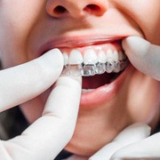 Dentist placing Invisalign aligner on patient's top teeth