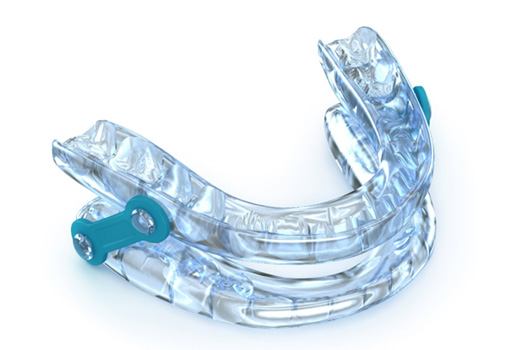 Clear oral appliance with blue hinge on white background