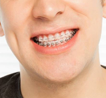 close-up of man’s braces