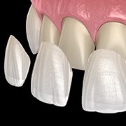 3D illustration of veneers in Los Alamitos 