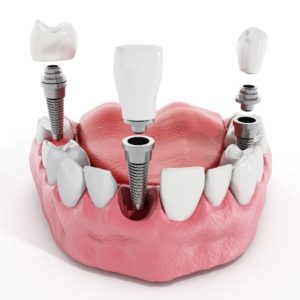 dental implants