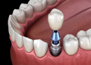model of dental implant